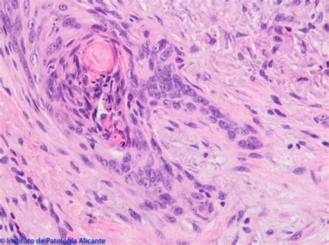 Carcinoma Basocelular Instituto De Patología Alicante