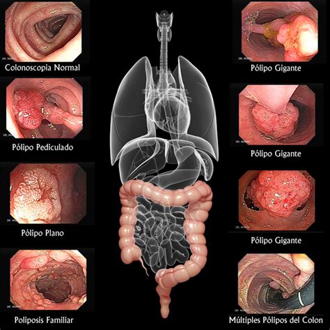 C Mo Se Forma Un C Ncer Gastroenterologia El Salvador Murrasaca