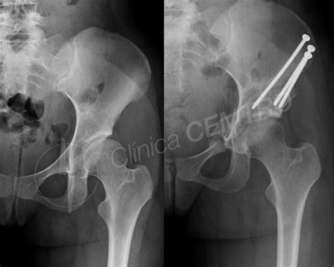 Osteotomía Periacetabular Clínica CEMTRO