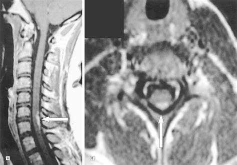 Spinal Neurosarcoidosis Mimicking An Idiopathic Inflammatory