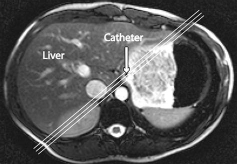 Gastroesophageal Junction Ultrasound