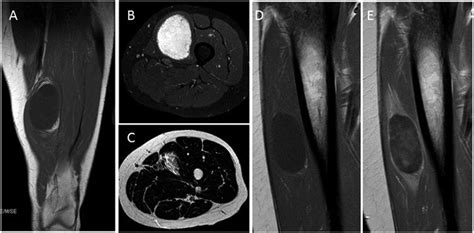 Intramuscular Myxoma T1 Weighted Sequence A Reveals Ovoid