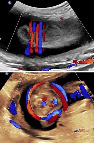 Full Article Current Perspectives Of Prenatal Sonographic Diagnosis