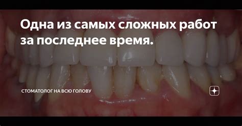 Одна из самых сложных работ за последнее время. | Стоматолог на всю ...