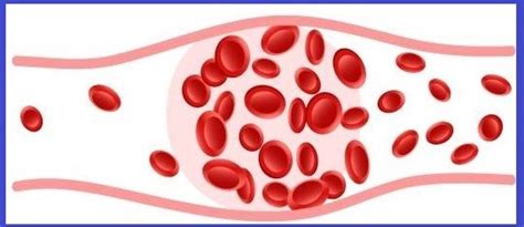 Thrombose Et Cancer Anticoag Pass S D