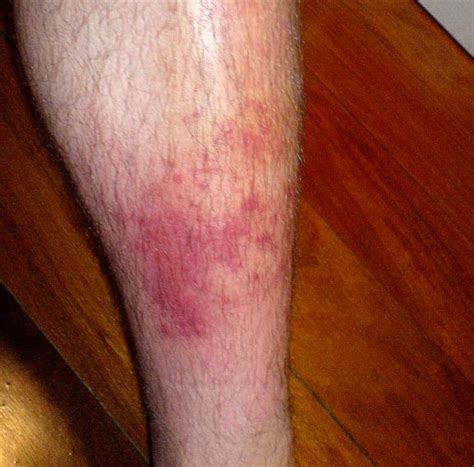 What Is Cellulitis What Causes Cellulitis Infection The Dynamic Natural Skin Care