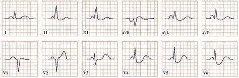 Jpm Free Full Text Broad Electrocardiogram Syndromes Spectrum From Common Emergencies To