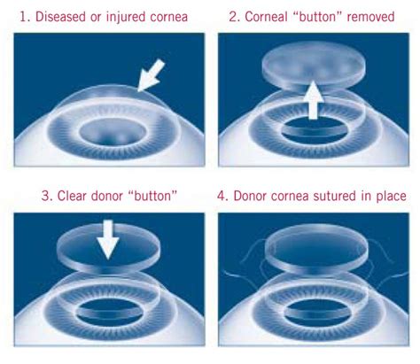 Corneal Transplant Surgery