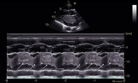 M Mode Echocardiography In Parasternal Long Axis View Showing Systolic