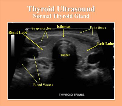 Normal Thyroid Measurements Ultrasound