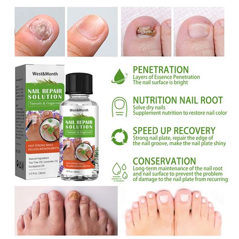 Iirich Toenail Fungus Treatment For Toenail Or Fingernail Fast Acting