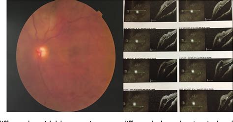 Figure 2 from Ocular Manifestations of the Sturge–Weber Syndrome ...