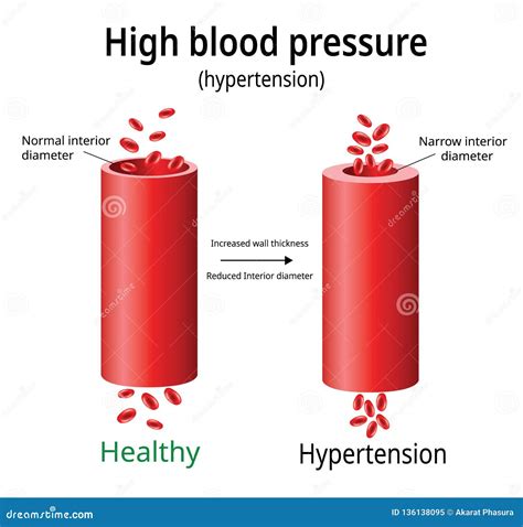 Hypertension Cartoons, Illustrations & Vector Stock Images - 10660