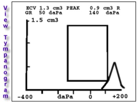 Tympanometry – Department of Pediatrics – UW–Madison