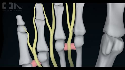 Minimally Invasive Mortons Neuroma Surgery Youtube