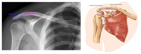 Luxa O Acromioclavicular Dra Ver Nica Chang