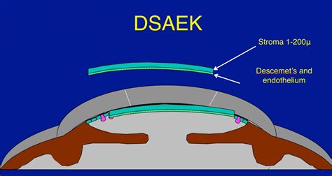 Dsaek Corneal Transplantation Image Eurekalert Science News Releases