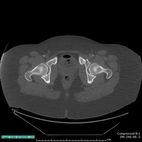 Pelvic Anatomy Ct