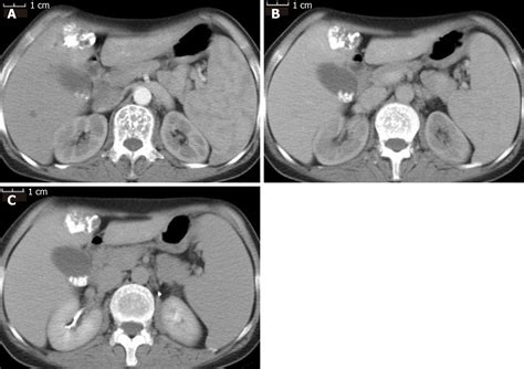 Solitary Hepatic Lymphangioma Mimicking Liver Malignancy A Case Report