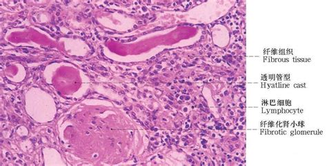 241 慢性硬化性肾小球肾炎② 病理学图谱 医学