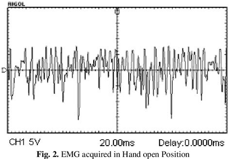 Figure From Development Of Threshold Based Emg Prosthetic Hand