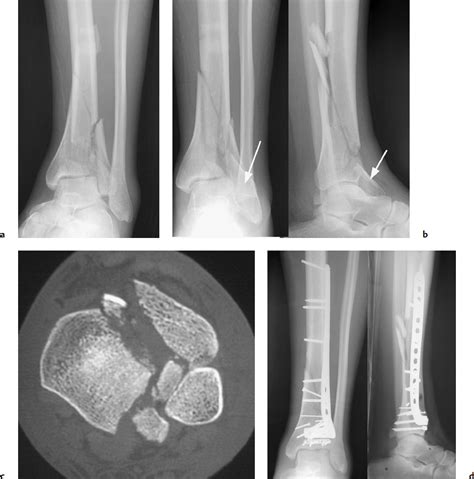 Distal Tibia Fractures Radiology Key