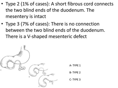 Duodenal Atresia Stenosis Pranaya Ppt