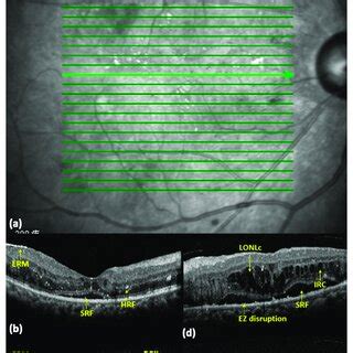 OCT biomarkers in diabetic macular edema (DME) eyes. (a) A ...