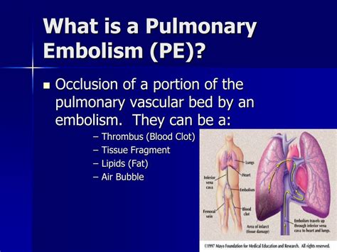 Ppt Dvt Prophylaxis And Pulmonary Embolism Powerpoint Presentation Free Download Id 3622002