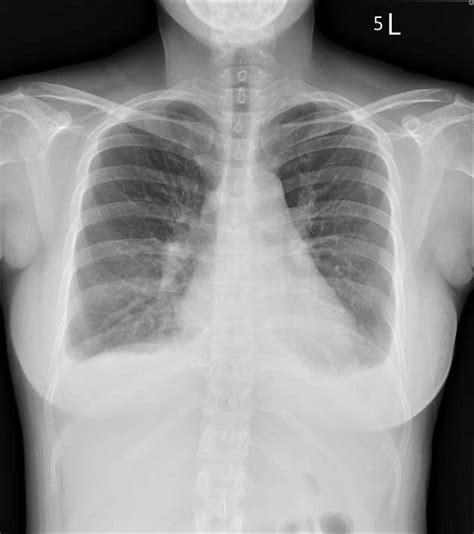 Chest X Ray Showing Cardiomegaly And Pulmonary Edema Download