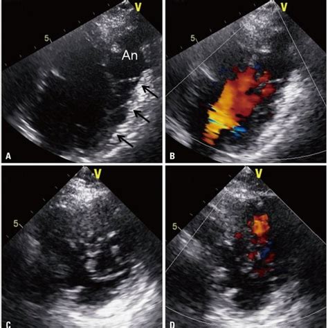 Transthoracic Echocardiography A A Modified 4 Chamber View Showing