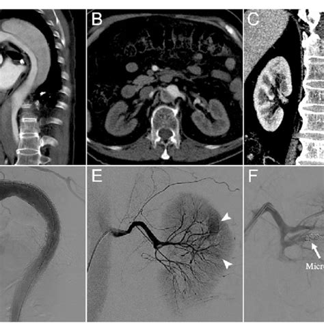 A Preoperative Sagittal Computed Tomography Angiography Showed A Type Download Scientific