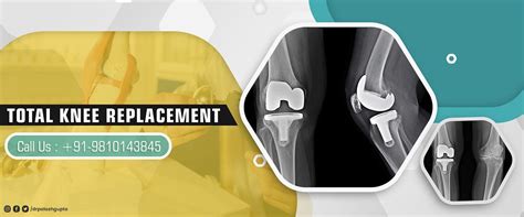 Your Path to Recovery: Total Knee Replacement Surgeon Tips” | by ...