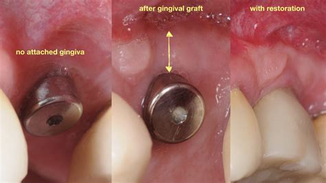 Gum Gingival Graft For Inadequate Attached Gingiva Around Final