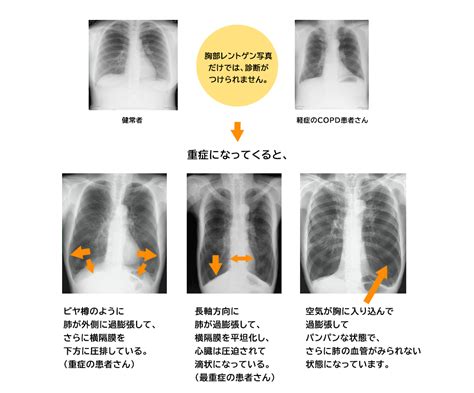 Copdの診断と検査｜医療法人啓生会 やすだ医院は、京都市南区にある呼吸器疾患を専門とする医療機関です。