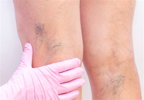 Understanding Spider And Thread Veins Causes Treatments And Measures