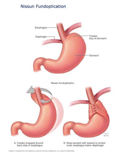 Medsurg Exam 4 Flashcards Quizlet