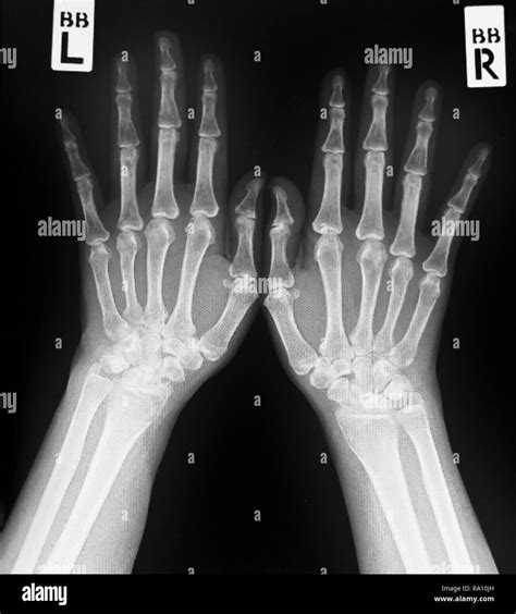 Hand Anatomy Xray - Anatomical Charts & Posters