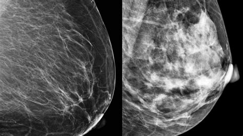 Breast Cancer Risks Density Risk Factors