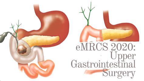 Upper Gastrointestinal Surgery Youtube