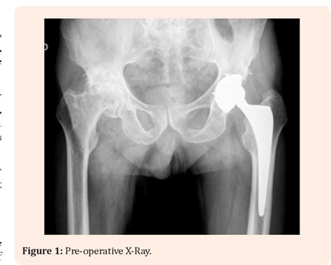 Figure From Compressive Iliac Aneurysm A Rare Case Of Sciatic Nerve