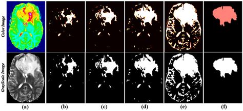 Illustrated A Region Growing Segmentation Of A Brain Tumor From Left