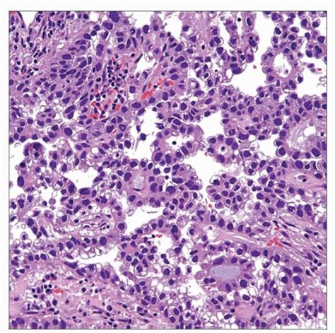 Clear Cell Adenocarcinoma Basicmedical Key