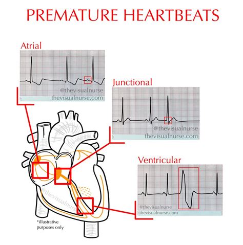 Premature beats on the ECG: where are they originating (for nurses & nursing students)? — The ...