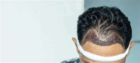 Hair Transplant Success Rate What To Expect Cosmedica