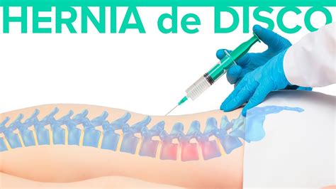 Cuál es el MEJOR TRATAMIENTO para la hernia discal Hernia de disco