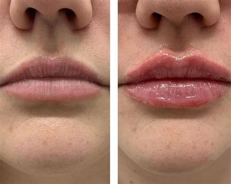 Lip Filler Vs Lip Flip