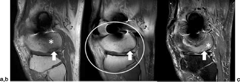 Lateral Femoral Condyle Avulsion Fracture