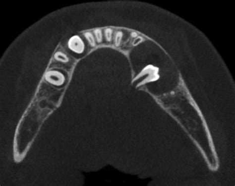 Of Ultrasonography In Maxillofacial Intraoral Benign And Malignant