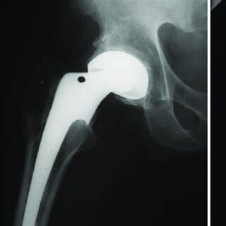 X Ray Right Hip Joint Anteroposterior View In A 35 Year Old Male